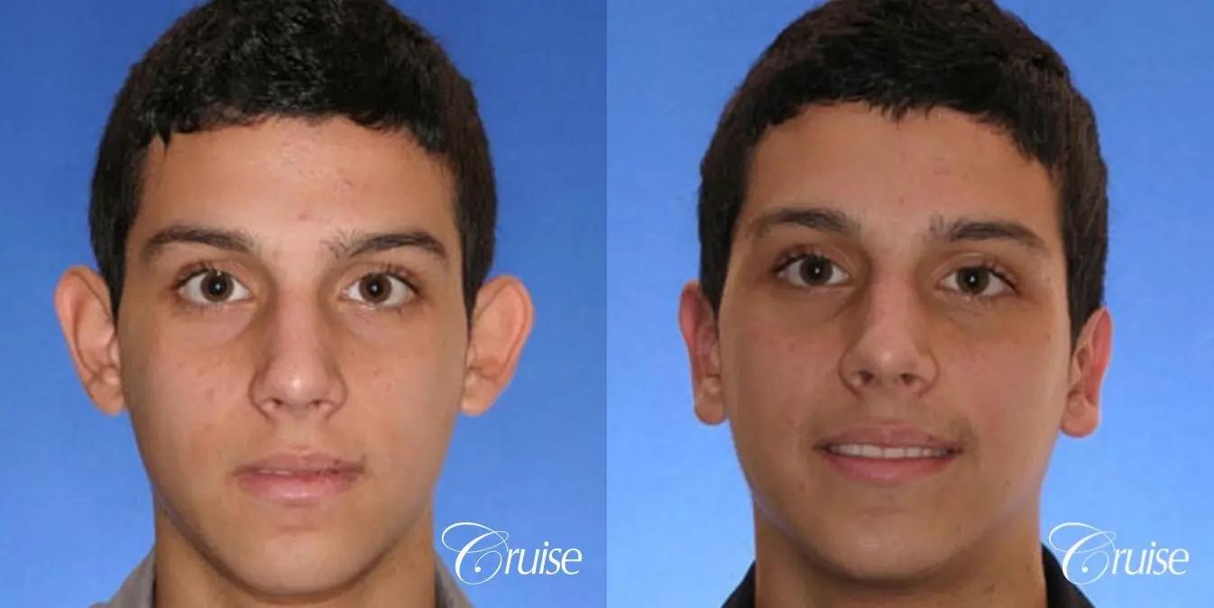 best otoplasty pictures on male teen in Newport Beach - Before and After 1