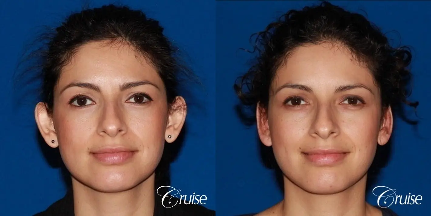 best otoplasty with natural appearance on female - Before and After 1