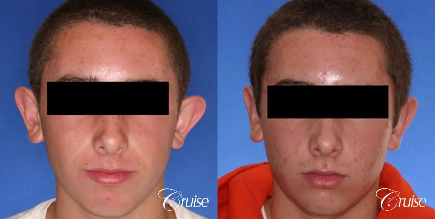 teen boy gets otoplasty in Newport beach - Before and After 1