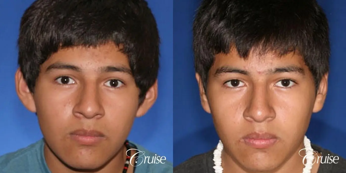 best otoplasty on young boy - Before and After 1