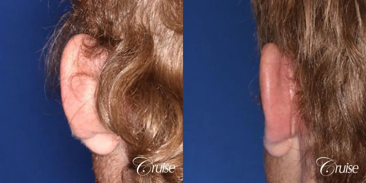 otoplasty before and after pictures newport beach - Before and After 3