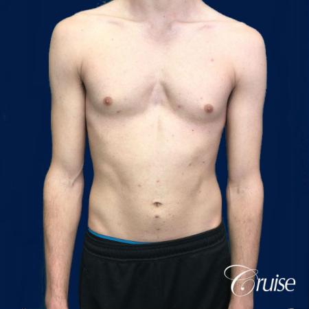 Top Gynecomastia Specialist Dr. Cruise - Before Image 1