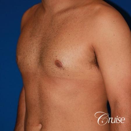 moderate gynecomastia on adult - After 3