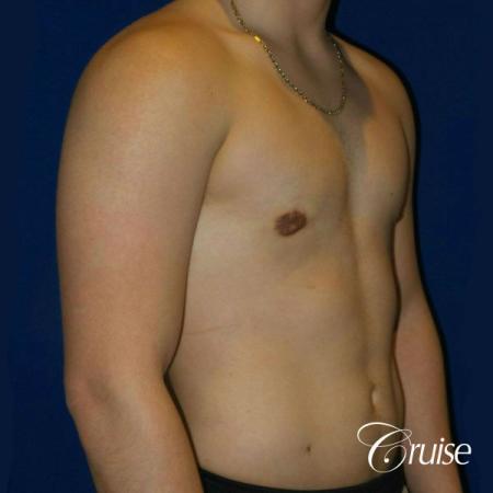 Best Gynecomastia surgeons Southern California - After Image 4