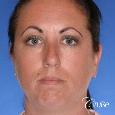 before and after photos of female chin implant - Before Image 1