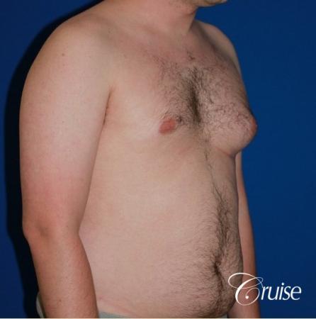 asymmetric gynecomastia moderate - Before and After Image 4