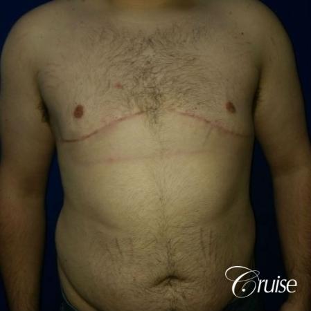male breast reduction surgery orange county - After 1