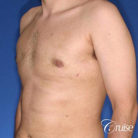 moderate gynecomastia puffy nipple - After Image 3