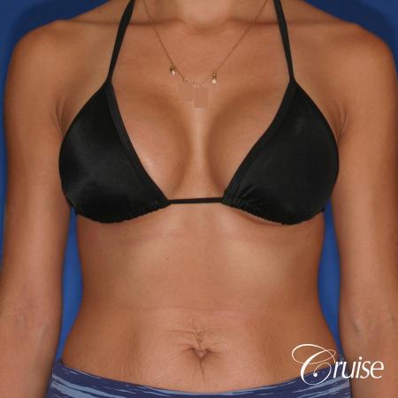 Breast Augmentation - After 4