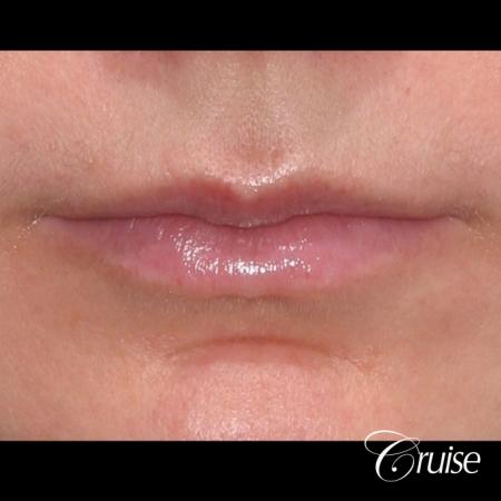 best before and after of lip filler - Before Image 1