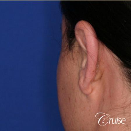 best male otoplasty orange county plastic surgeon - After Image 2