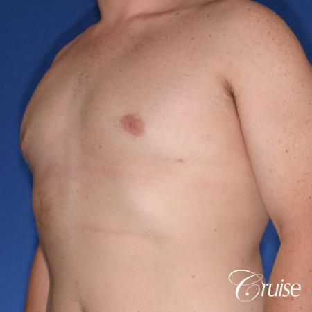 moderate gyne on teen with best pictures - After Image 3