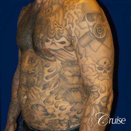 Moderate Gynecomastia Areola Incision - After Image 3