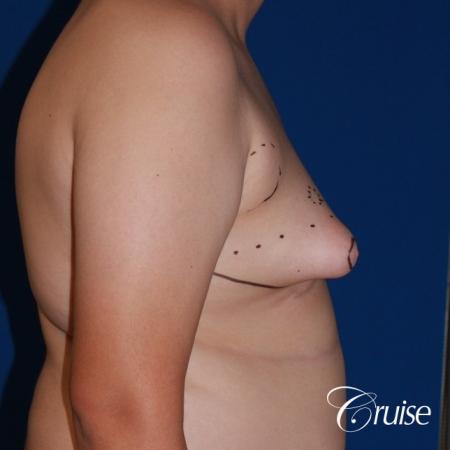 young boy with gynecomastia during puberty gets surgery - Before and After Image 4