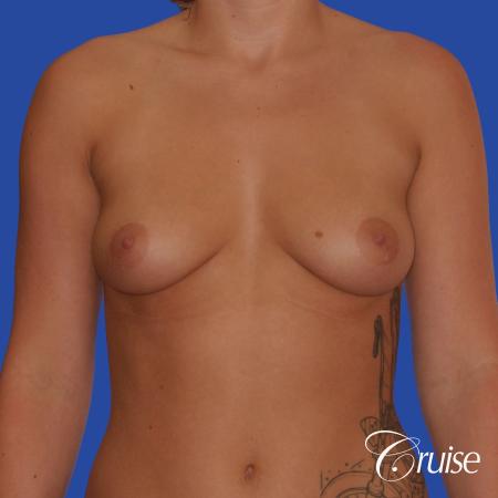 Breast Augmentation - Before Image 1