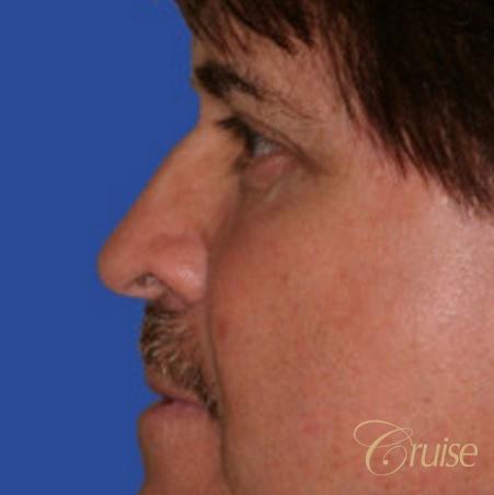 male has brow lift with face lift -  After 2