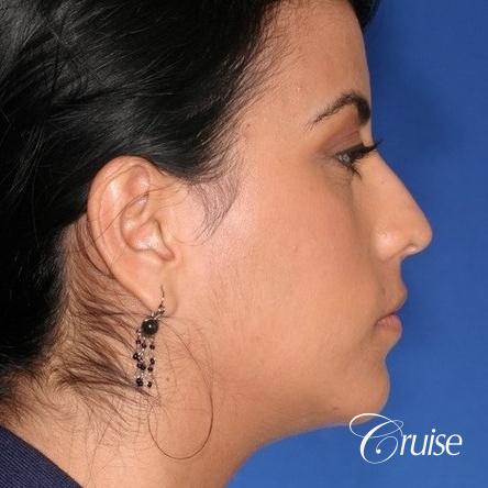 best XL chin implant on female patient - After Image 4