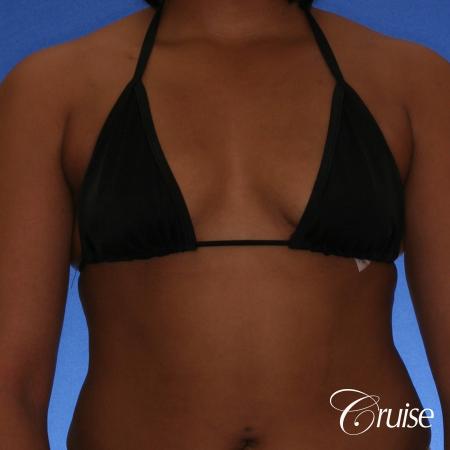 Breast Augmentation - Before and After Image 4