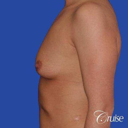 Breast Augmentation - Before and After Image 2