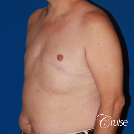 male breast severe gynecomastia free nipple graft anchor - After Image 3