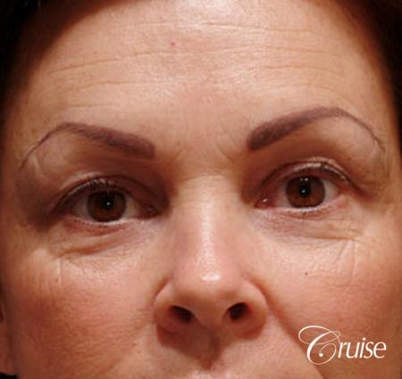 best blepharoplasty eye surgery photos - Before Image 1
