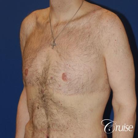severe weight loss gynecomastia upper body lift - 1 After Image 2
