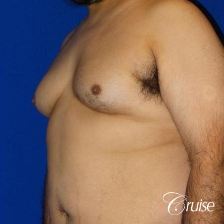 Gynecomastia -Free Nipple Graft - Before Image 2