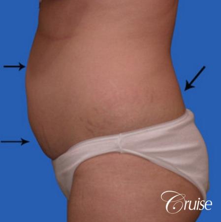 liposuction on abdomen photos - Before and After Image 2