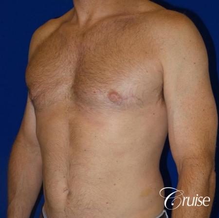 best gynecomastia results on 45 year old - After Image 2