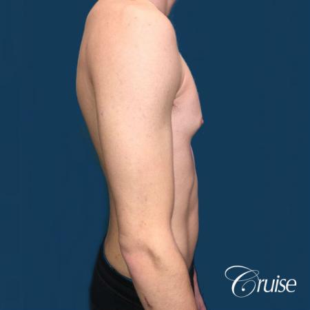 Top Gynecomastia Specialist Dr. Cruise - Before Image 4