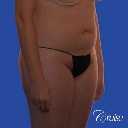 best pictures of liposuction with plastic surgeon in Newport Beach - Before Image 4