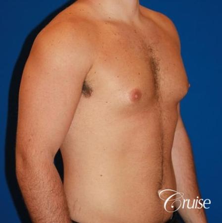 athletic adult with puffy nipple - Before Image 3