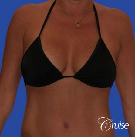 photos of best breast lift anchor with saline implants in Newport Beach - After Image 3