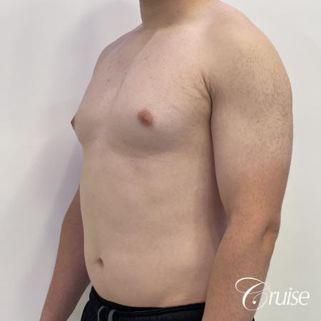 Gynecomastia: Patient 123 - Before 2