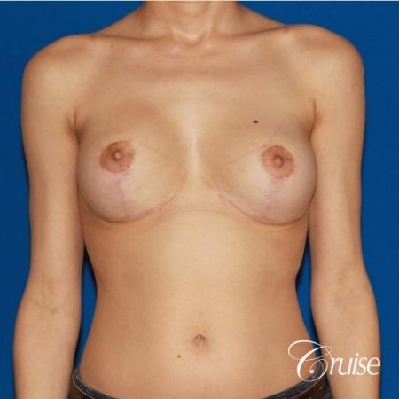 best breast lift revision with moderate profile silicone implants - After Image 1