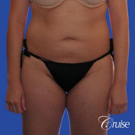best full body liposuction abdomen flanks thighs knees - Before Image