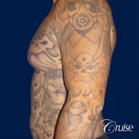 Moderate Gynecomastia Areola Incision - Before Image 2