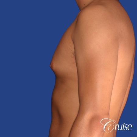 best gynecomastia results with plastic surgeon and specialist - Before Image 2