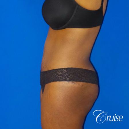 Best Tummy Tucks Orange County CA - After Image 3