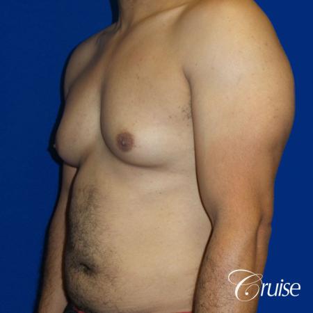 Best gynecomastia specialist in united states - Before Image 2