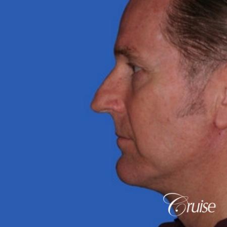 52 yr old male with medium square chin implant - After Image 2