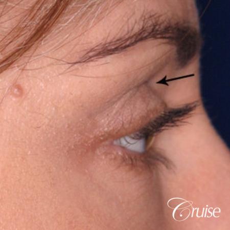 best soft tissue filler using Juvaderm - Before Image 2