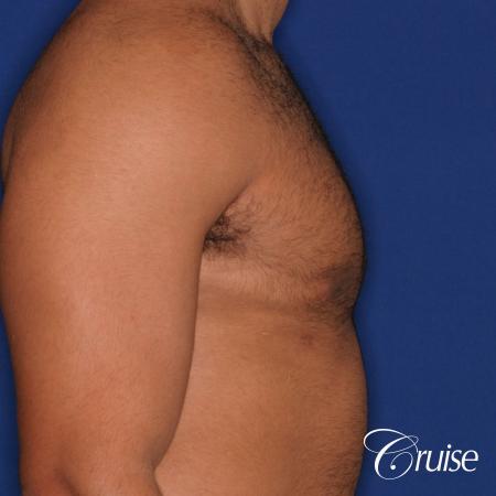 26 yo athletic patient with moderate gynecomastia - After Image 3