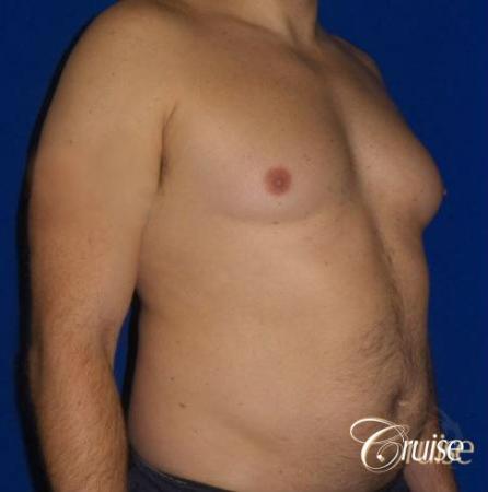 male breast reduction surgery - Before Image 2