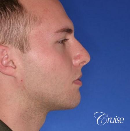 best chin implant on male with medium square jaw - After Image 3