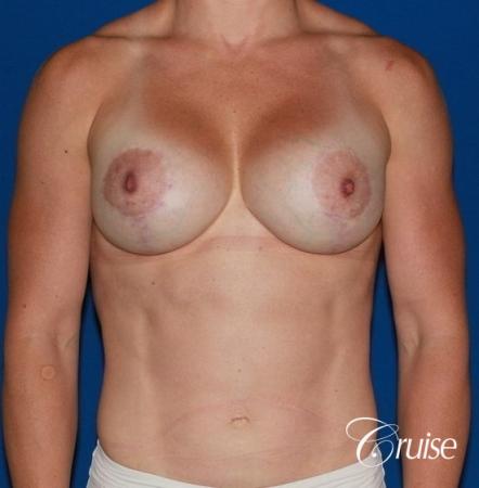 best breast lift anchor on athletic body type - After Image 1