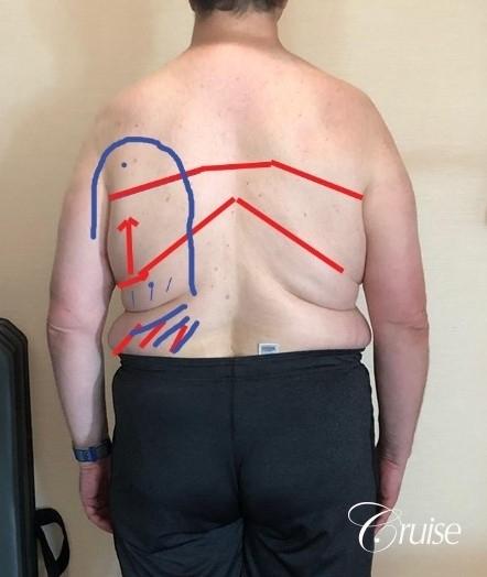 Gynecomastia Type 6; Circumferential Upper Body Lift; Liposuction to Upper Abdominal Rib Fat, Posterior Arms, Upper Back and Flanks - Before and After 3