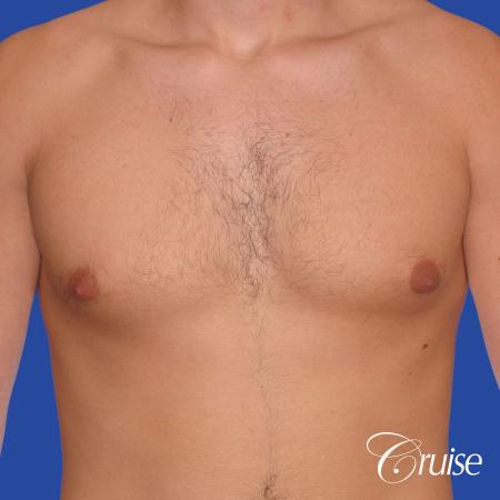 24 yr old body builder mild gynecomastia - Before Image 1