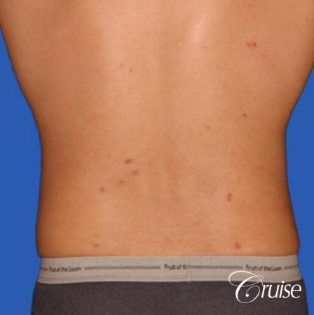 best liposuction to contour a males body - After Image 3