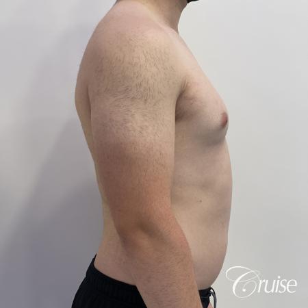 Gynecomastia: Patient 123 - Before and After 5